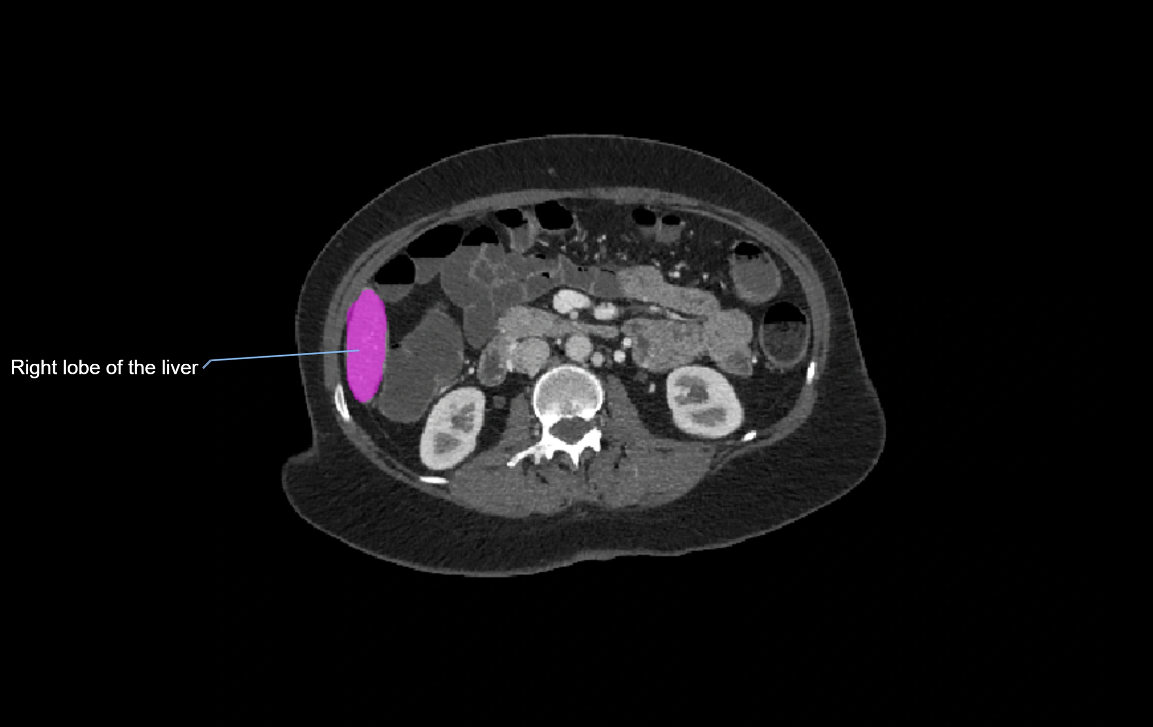 CT lliver lobes axial cross sectional anatomy labelled image -00011.webp